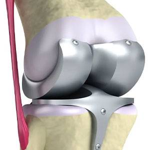 joint replacement in Vijayawada